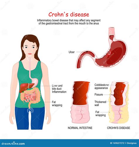enfermedad de crohn sintomas